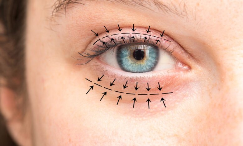 Blepharoplasty in Dubai