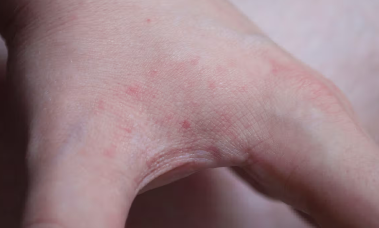 Bed Bug Bite Scars: How to Prevent and Treat Them